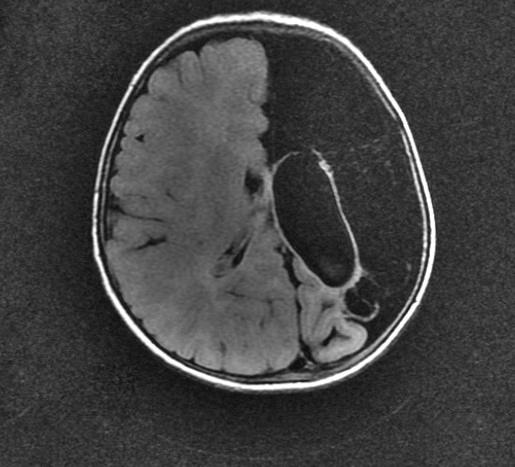 <b>Figure 2.</b> MRI Brain Axial T1 Sequence.